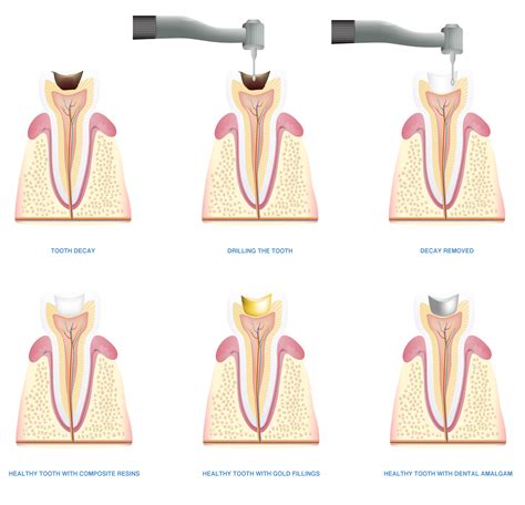 How Do Cavity Fillings Work? - Willow Pass Dental Care