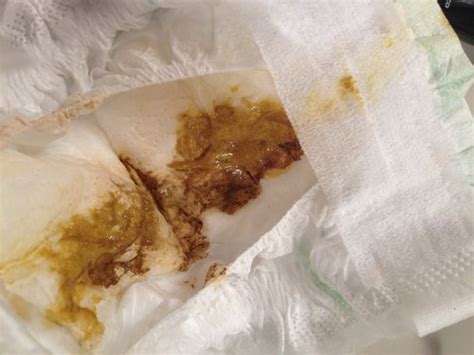 Amazing Brown Mucus Stool in 2023 Learn more here | stoolz