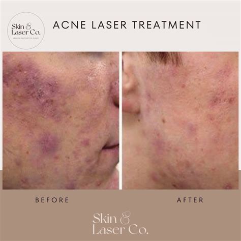 active acneacne scar treatment skin laser