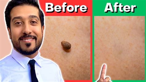how to remove a large skin tag at home