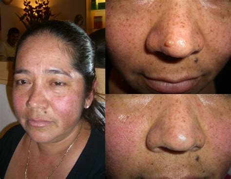 Skin Blemish Removal | Draper, Utah