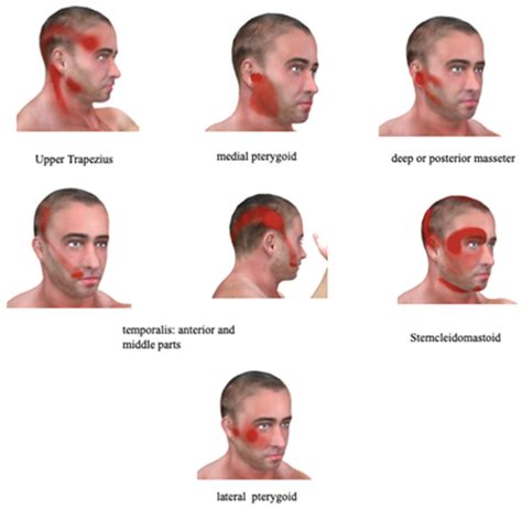 IJERPH | Free Full-Text | Chronic Facial Pain: Trigeminal Neuralgia