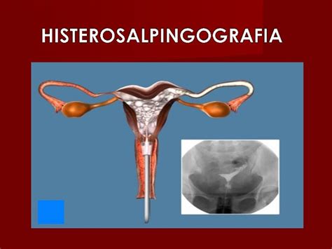Rayos Histerosalpingografia