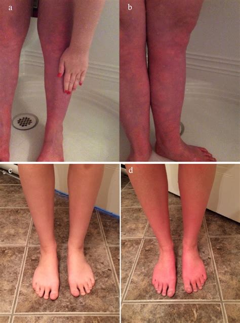 Pots Disease Exercise at Ralph Risinger blog