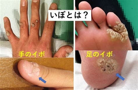 尋常性疣贅スピール膏, イボ 黒い点 取れた , ウイルス性イボ （尋常性疣贅） – BNVS