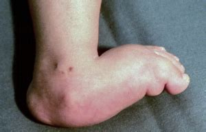 congenital vertical talus prof nicola portinaro orthopedic suregon