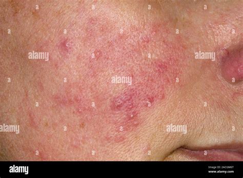 acne rosacea   cheek   face    year  female patient