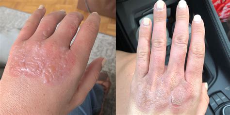 This Woman’s Blistering Burn Shows Why You Should NEVER Make a ...