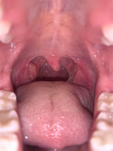 one tonsil is bigger than the other .. should I be concerned? : r/medical