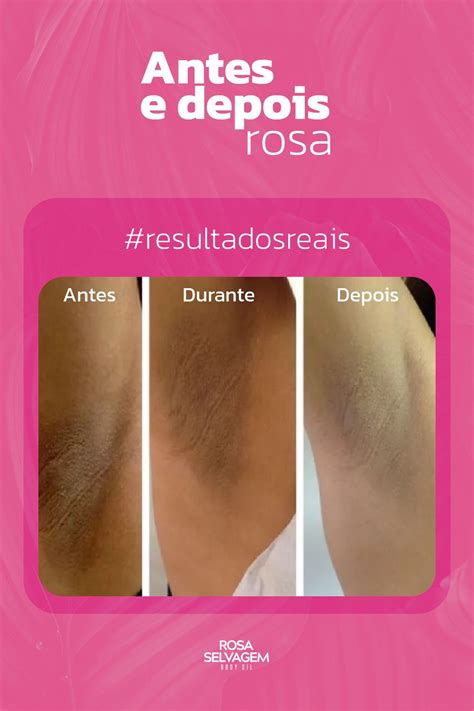 Rosa Selvagem Antes E Depois Virilha