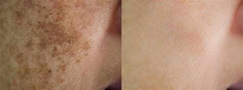 best treatment for face melasma 1