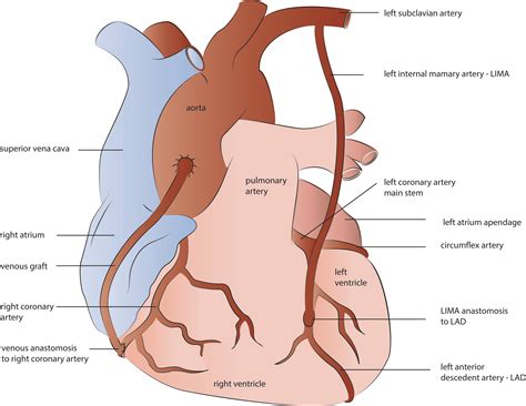 Pda Heart Surgery at Tracy Jacoby blog