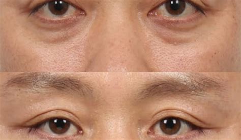 efil bulging eyes plastic surgery jci exophthalmos correction surgery