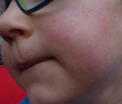 Was kann das für ein Ausschlag sein bei meinem Sohn ? (Gesundheit