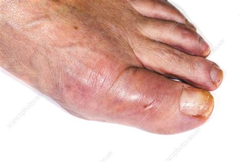 how to fix a broken big toe