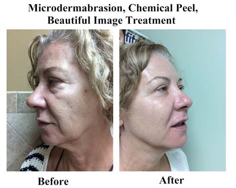 Microdermabrasion in Raleigh NC, Microdermabrasion Raleigh NC | Skin ...