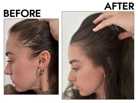 alopecia  women cure