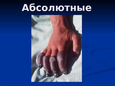 Ампутации и протезирование Ампутация Экзартикуляция