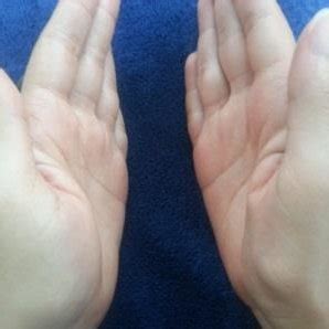 (PDF) Thenar Atrophy and Syncope as Signs of Thoracic Outlet Syndrome ...