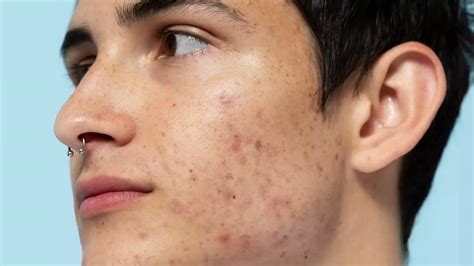 acne treatment acne medication creams pills