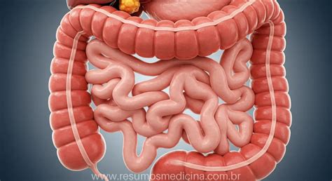 Oq E Obstrução Intestinal - Obstrução Intestinal: Causas, Diagnóstico e Tratamentos | ResumeAI ...