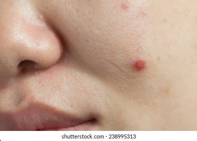 ingrown toenail granuloma inflamation close  stock photo