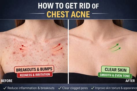 Chest Acne: Physician-Guided Diagnosis & Treatment Protocols
