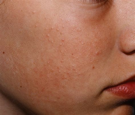 keratosis pilaris  symptoms    rid
