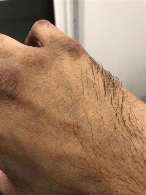 Bat bite? Do I need a rabies booster dose? From New York City : r/rabies