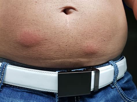 swelling  injections pharma trt  nation