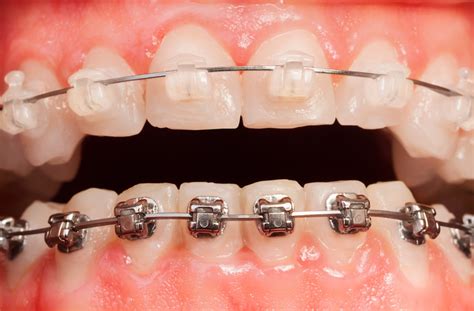 braces  brackets arrays  carroll zabala blog