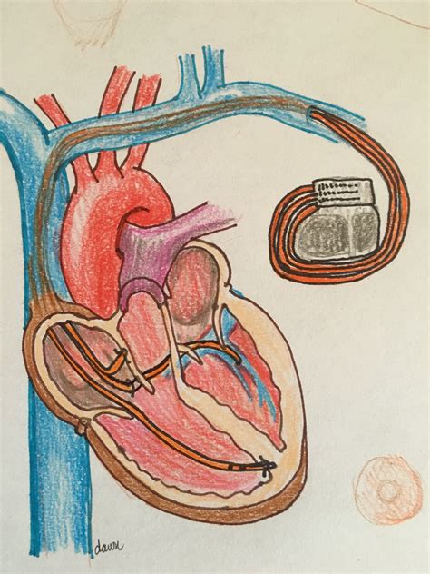 Bi-ventricular Pacemaker Illustration | ECG Guru - Instructor Resources