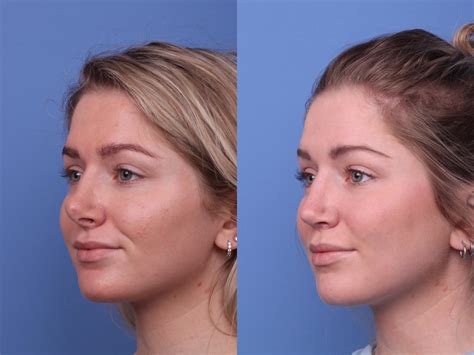 Good Rhinoplasty Before And After