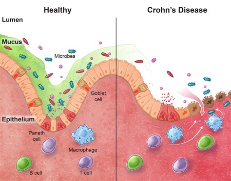 Crohn’s Disease - Helmsley Charitable Trust
