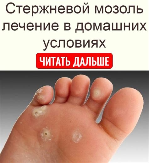Стержневой мозоль лечение в домашних условиях в 2020 г | Домашнее ...