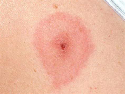 tick bite rash   recognize  symptoms treatment tips
