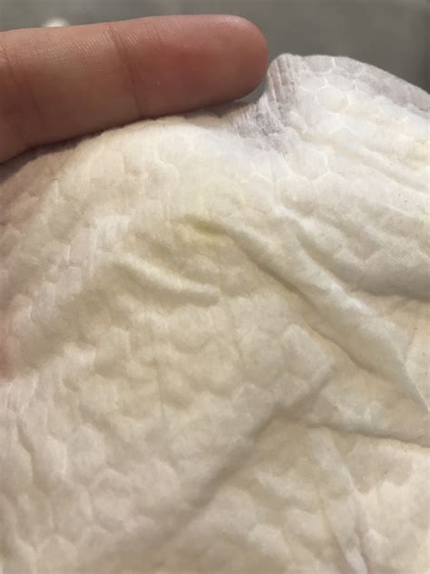 Clogged Milk Duct Discharge