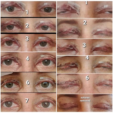 Lower Blepharoplasty Recovery Lower Blepharoplasty Before And After