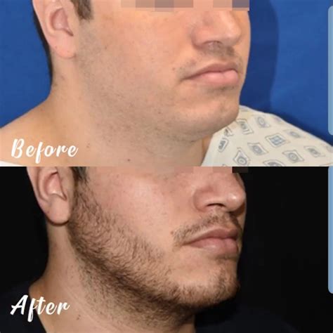 SUCCESS STORIES - Guerrero Plastic Surgery