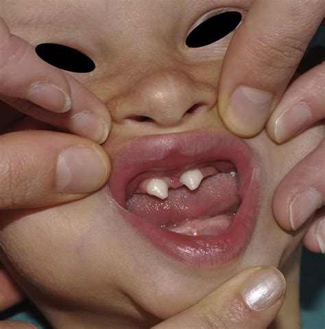 ectodermal dysplasia syndrome related healthjournals ectodermal