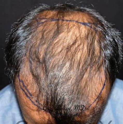 Follicular Unit Extraction (FUE) Overview: Cost, Recovery, Before ...