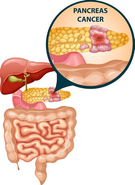 Pancreatic Cancer : Symptoms, Cause, and Treatments Options