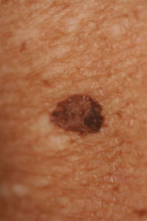 Superficial Spreading Melanoma On Back