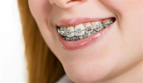 How Can Braces Fix An Overbite: Treatment Options And Duration