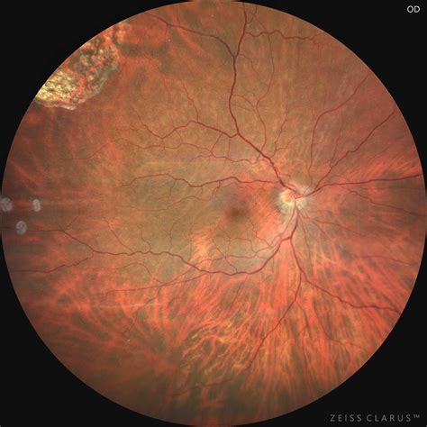 Retinal detachment: top of the line treatment in Tijuana