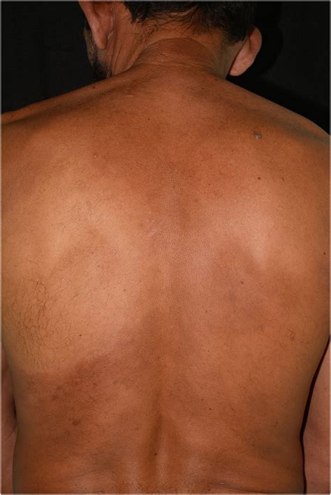 Borderline lepromatous leprosy with lymph node infiltration
