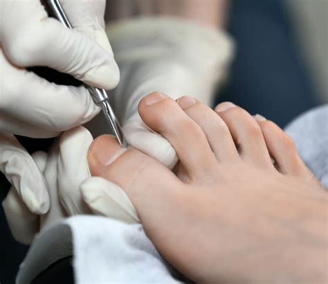 Fungal Nails | NC Foot Health | Bourne, Sleaford, Oundle