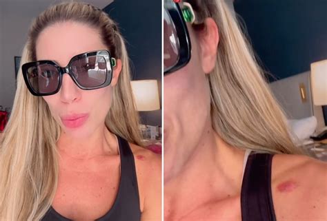Machucado Em Carne Viva O Que Passar - Tati Minerato mostra machucado após desfile: 'Tá na carne viva'