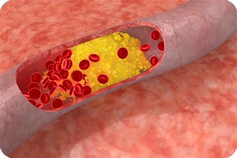 Colesterol Alto: O Guia Completo para Controlar LDL e HDL