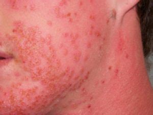 Skin infections and eczema - National Eczema Society